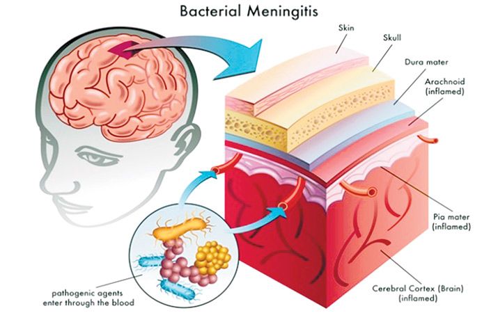 Meningitis secara umum