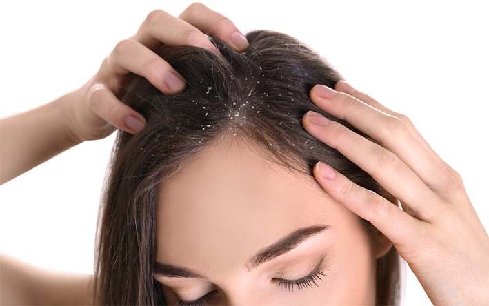 Bahan Aktif Nizoral-SS Shampoo Untuk Mengatasi Ketombe