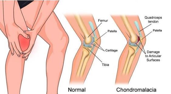 Kondromalasia Patella