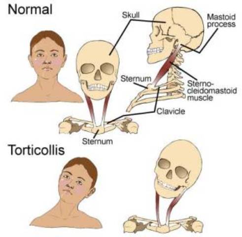 Tortikolis Spasmodik