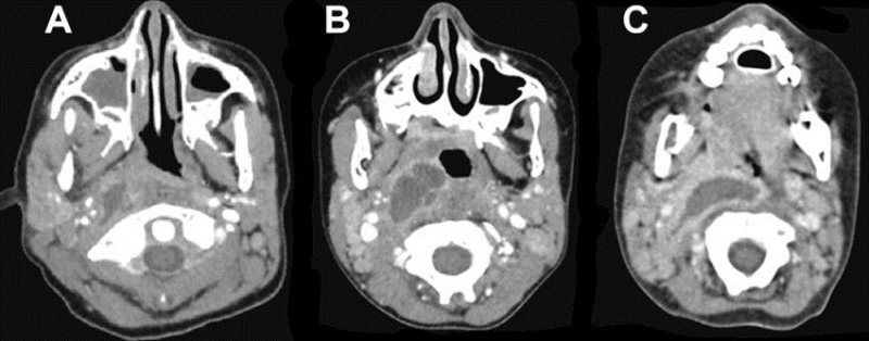 Abses Parafaringeal