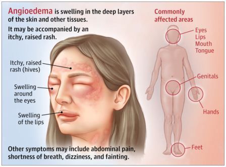 Angioedema Herediter