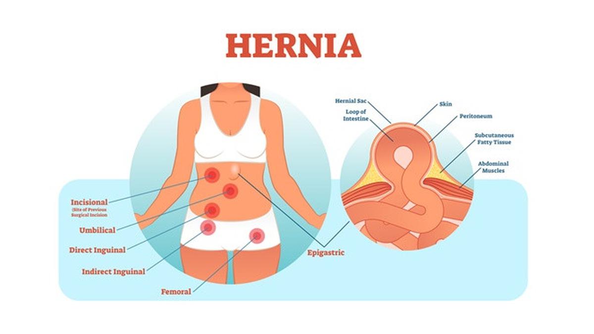 Hernia Pada Dinding Perut