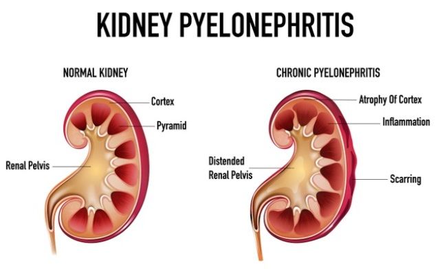 Pielonefritis - Infeksi Ginjal