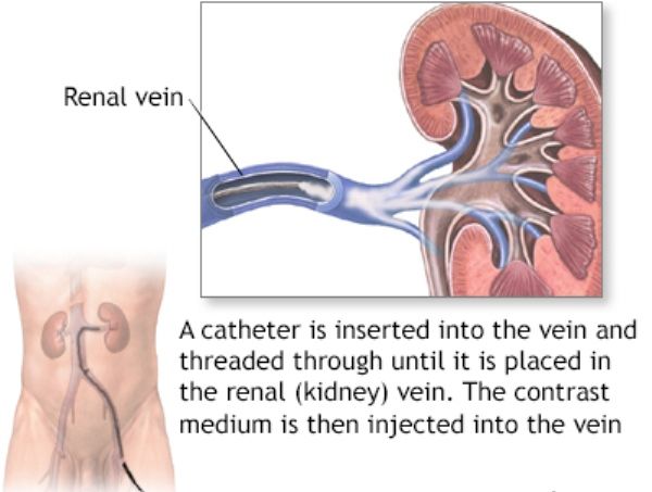 Venogram Ginjal