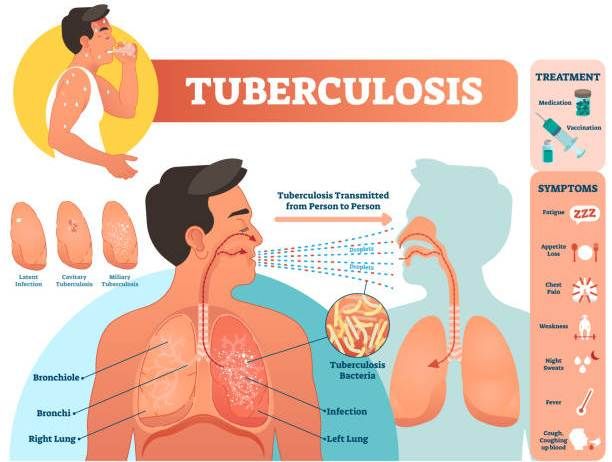 Tuberkulosis (TBC)