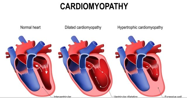 Kardiomiopati 
