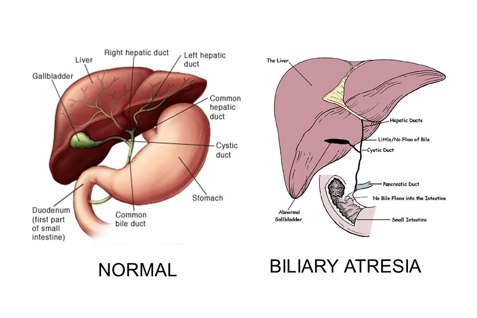 Atresia Bilier