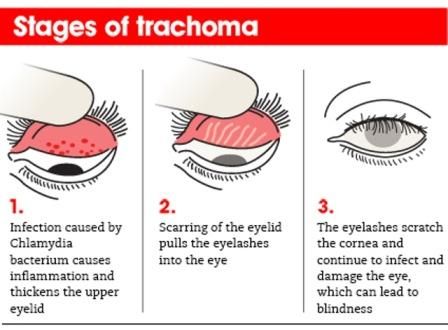 Trakoma