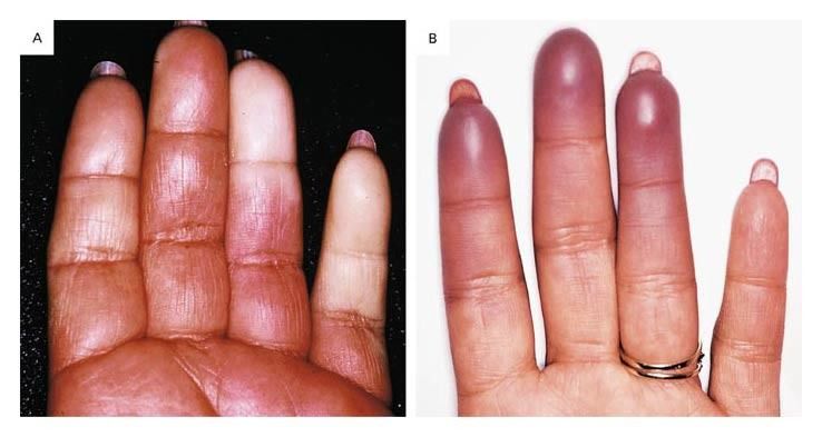 Fenomena Raynaud