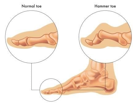 Hammer Toe (Jari Kaki Palu)