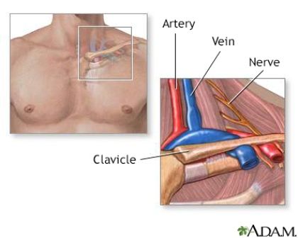 Sindroma Saluran Thoraks (Thoracic Outlet Syndrome)