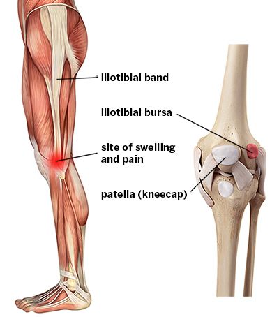 Sindroma Iliotibial Band (Iliotibial Band Syndrome, ITBS)