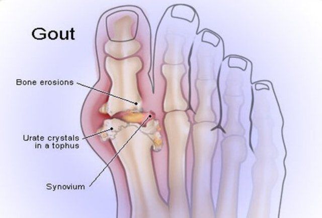 Gout (Asam Urat)