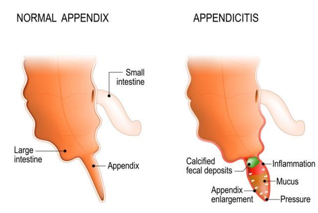 Radang Usus Buntu (Appendisitis) pada Anak