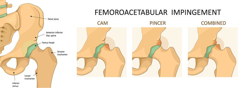 Femoroacetabular Impingement