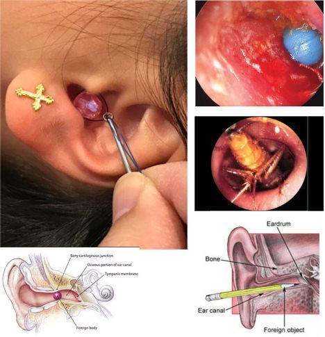 Kemasukan Benda Asing ke Hidung dan Telinga