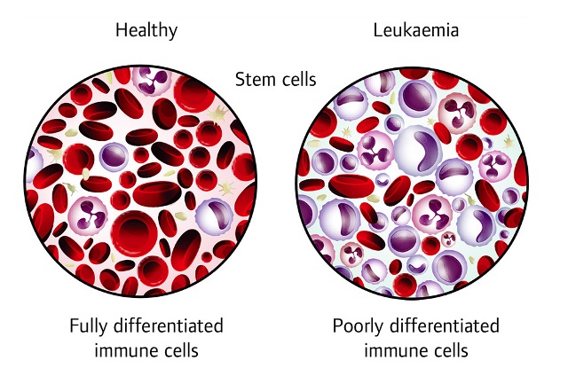 Leukemia Mieloid Akut