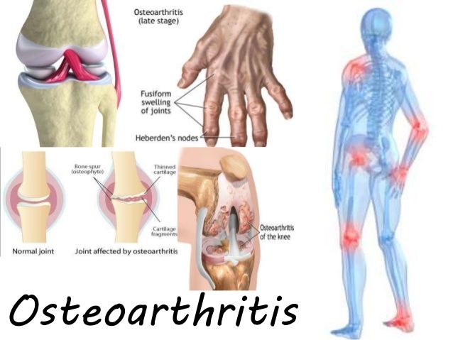 Osteoarthritis