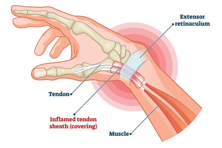 De Quervain's Tenosynovitis