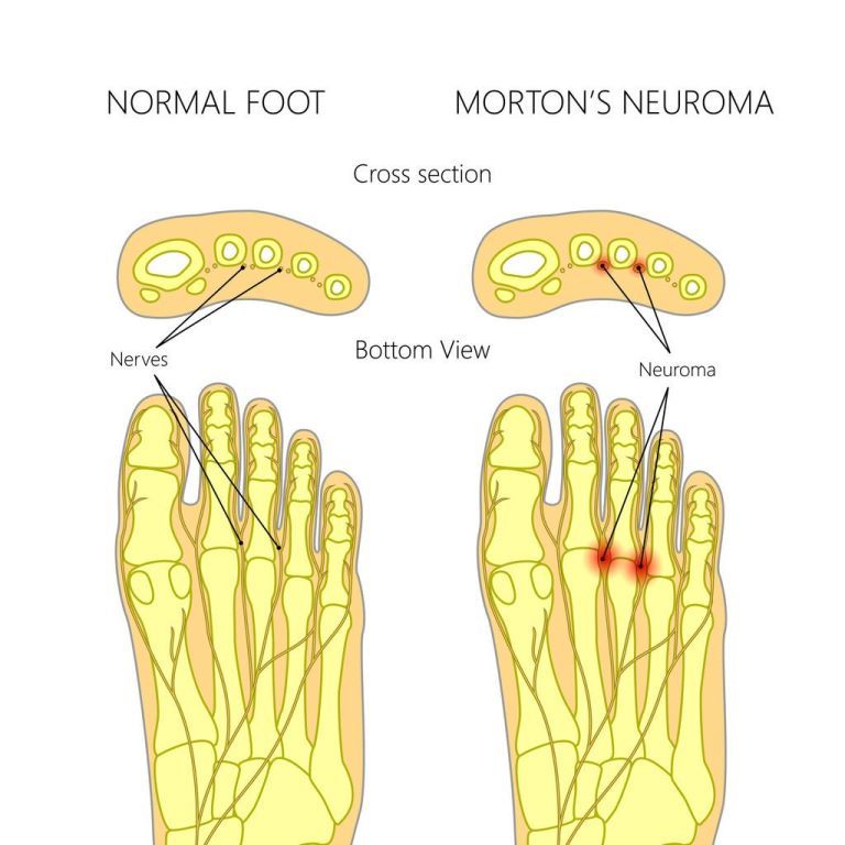 Neuroma Morton