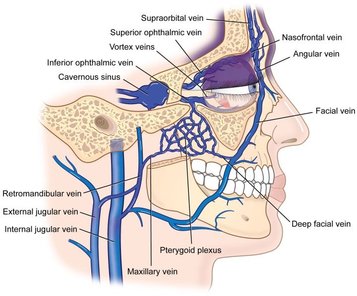 Thrombosis Sinus Kavernosus