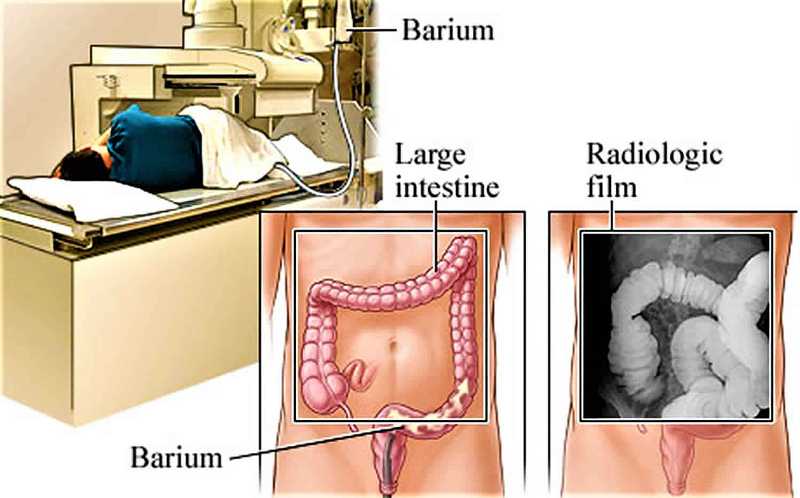 Pemeriksaan Barium Enema