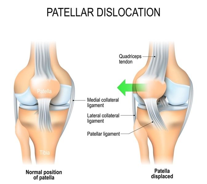 Dislokasi Patella