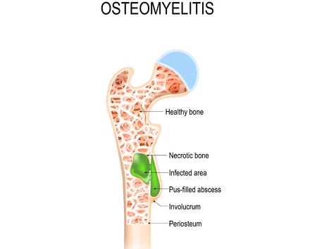 Osteomielitis