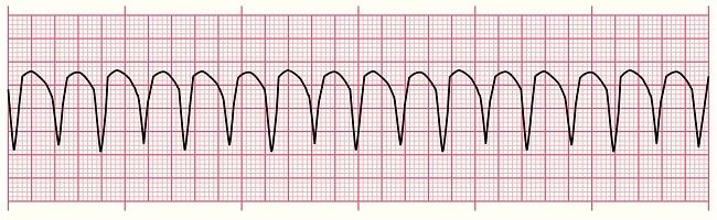 Takikardi Ventrikel