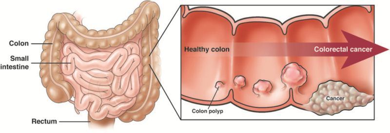 Kanker Kolorektal