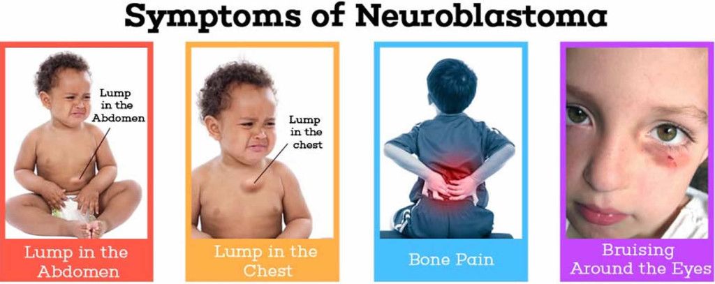 Neuroblastoma