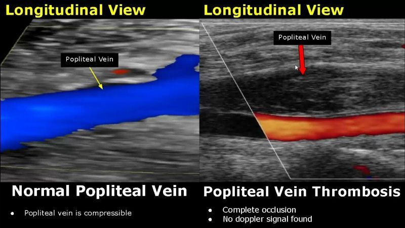 Ultrasonografi Doppler