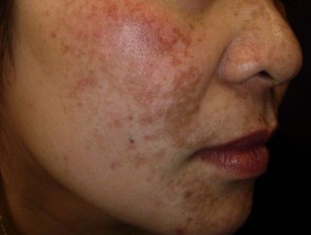 Melasma (Chloasma, Topeng Kehamilan)