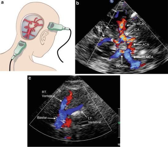 Ultrasonografi Doppler Sirkulasi Otak