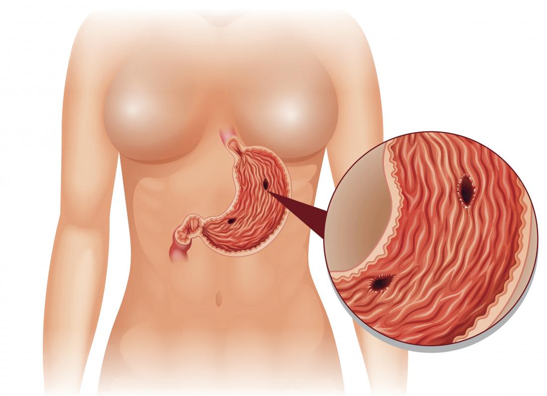 Perforasi Saluran Cerna