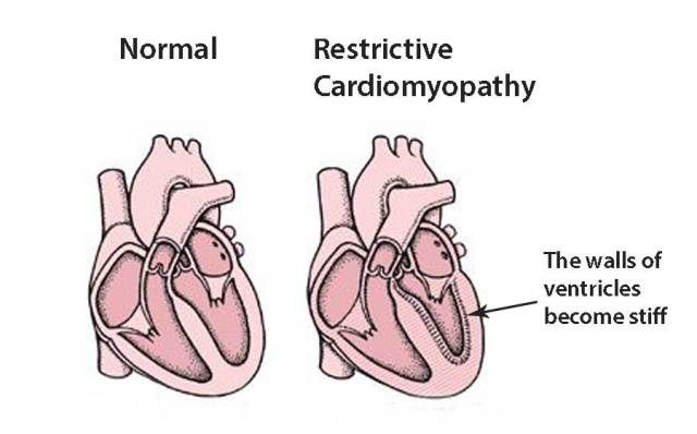 Kardiomiopati Restriktif