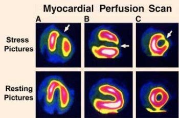 Sidik Perfusi Miokard
