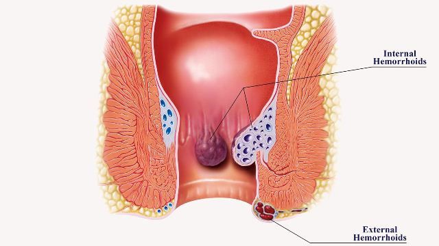 Hemoroid (Ambeien atau Wasir)