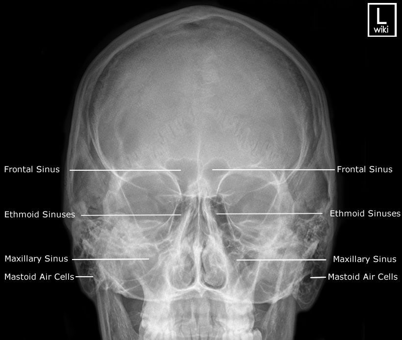 Rontgen Sinus