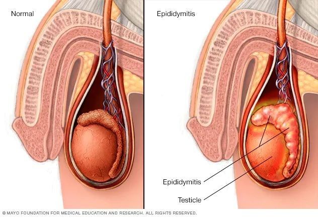 Epididimitis