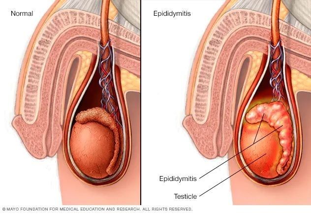 Epididimitis