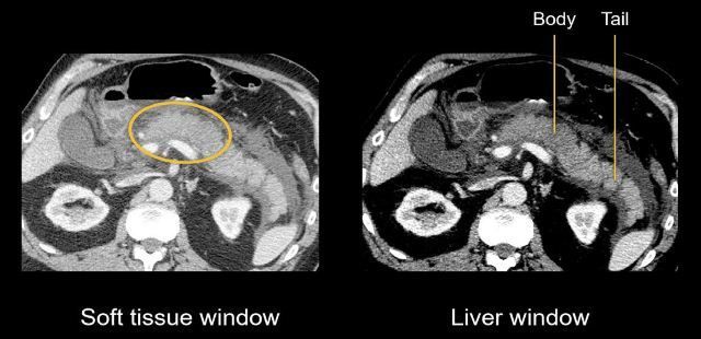 CT Scan Pankreas
