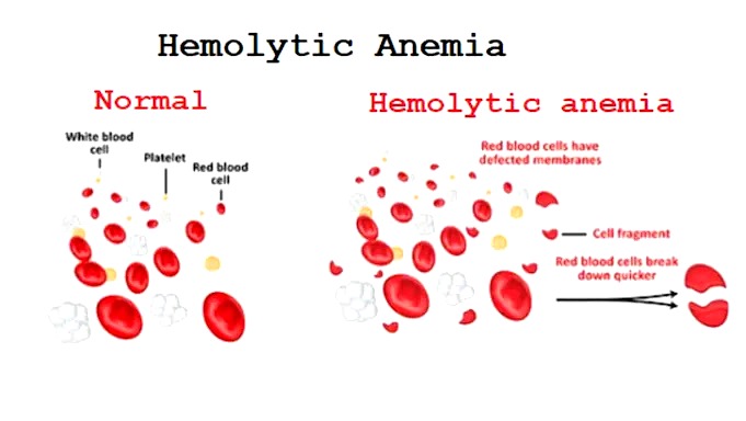 Anemia Hemolitik