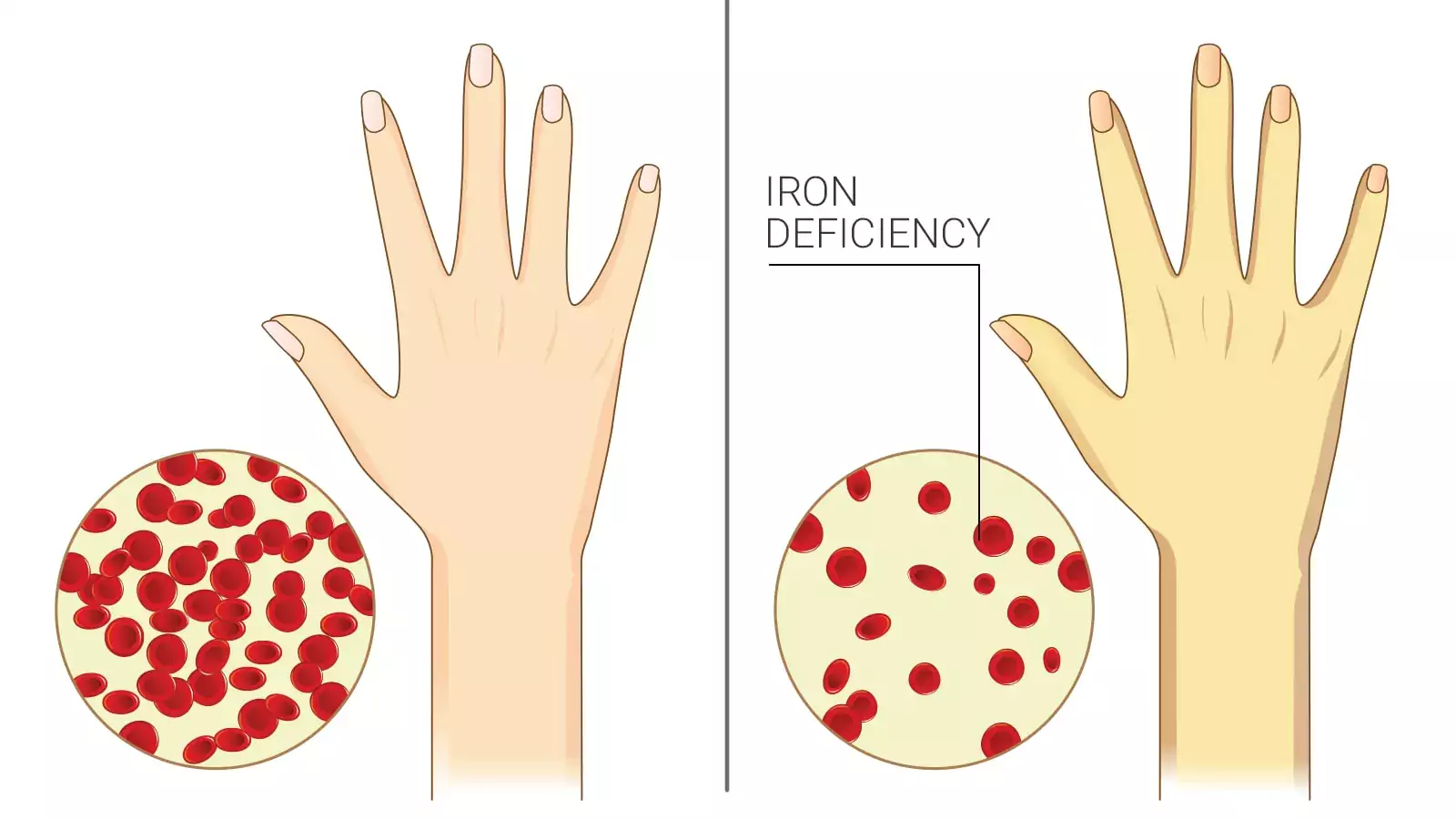 Anemia Kekurangan Zat Besi