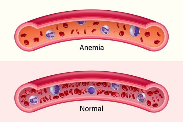 Anemia Karena Penyakit Kronis