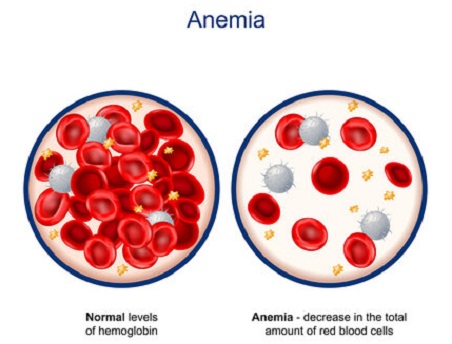 Anemia Karena Perdarahan Hebat