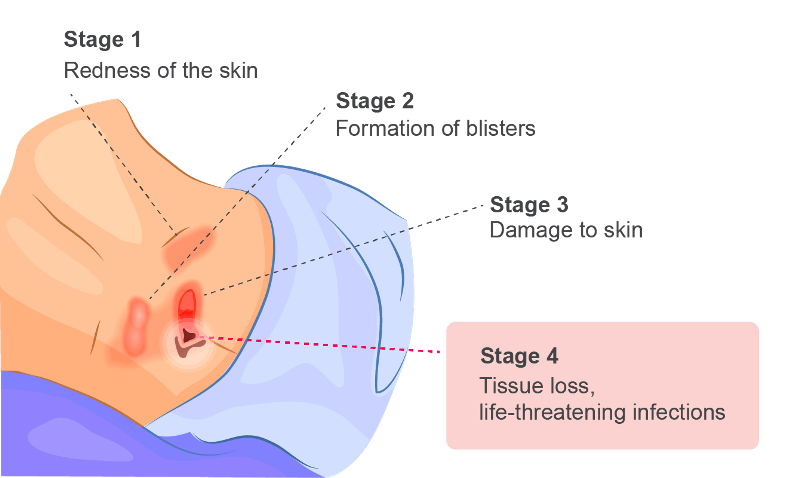Ulkus Dekubitus (Bedsores)