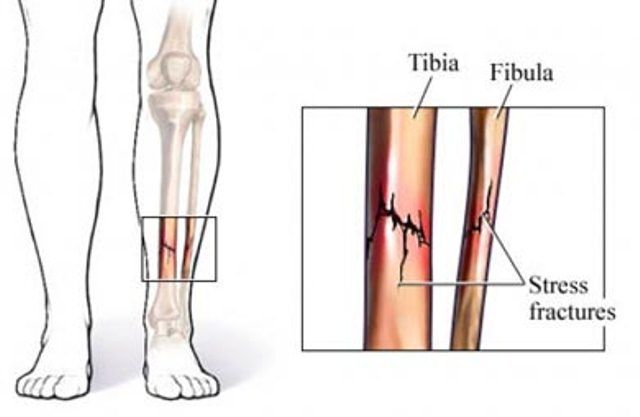 Patah Tulang Kaki Karena Tekanan (Stress Fracture)