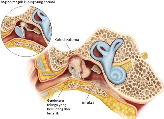 Kolesteatoma